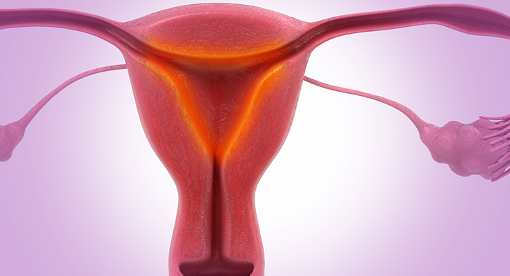 Endometrite pós-parto: sintomas e tratamentos