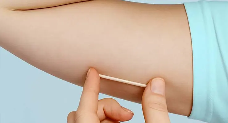 Anticoncepcional Implanon: 7 benefícios deste método contraceptivo de longa duração